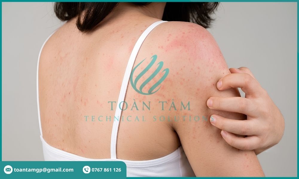Da bị kích ứng do dùng nước phèn